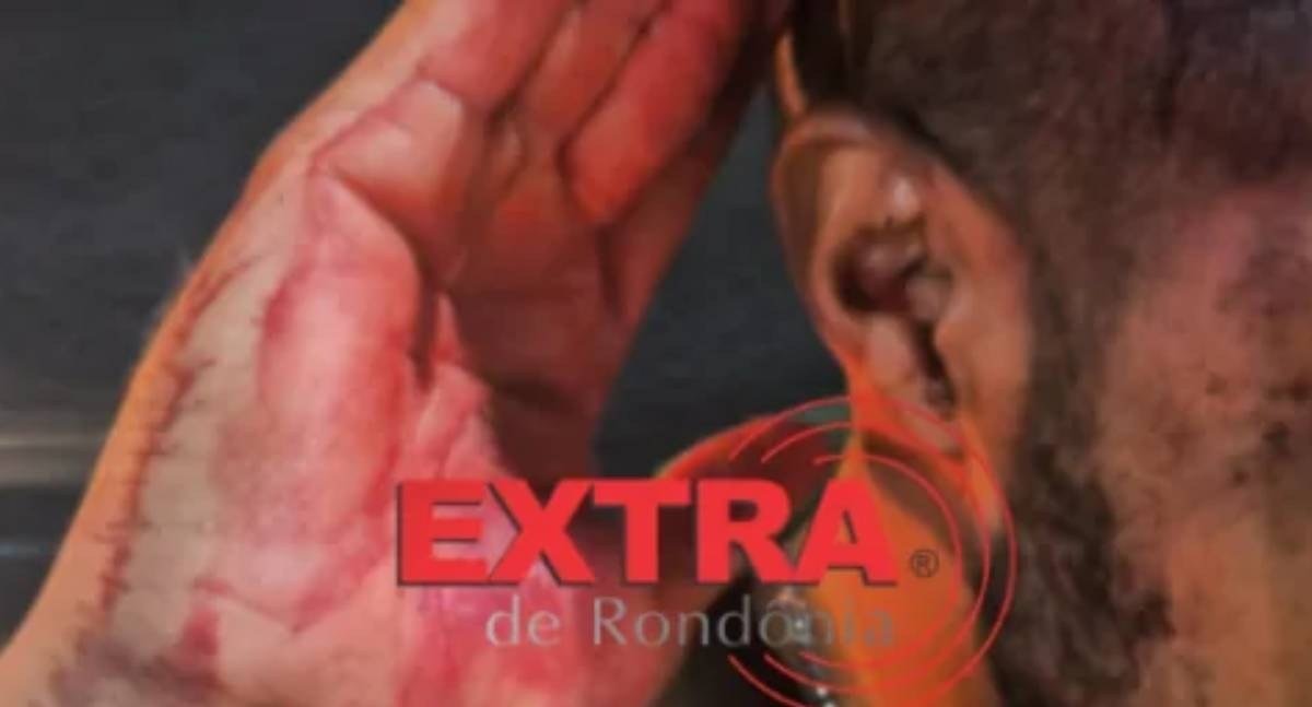 Homem é agredido com taco de sinuca na cabeça no decorrer de discussão em bar de RO